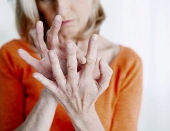 lo que necesitas saber sobre la artritis reumatoide