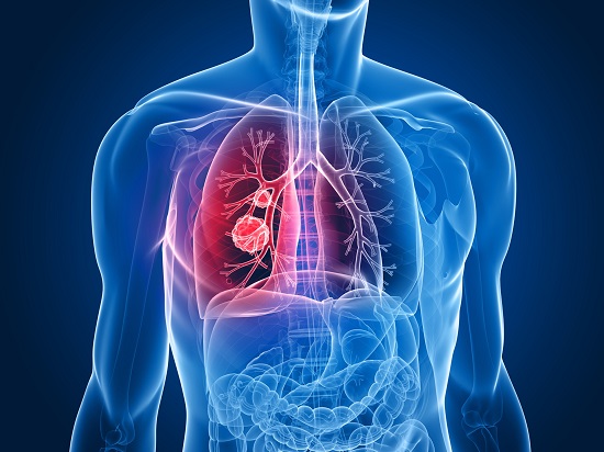 cncer de pulmn