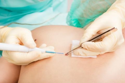 cáncer del piel, tratamiento cáncer del piel, tratamiento