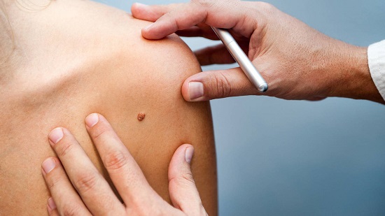 melanoma, un tipo de cncer