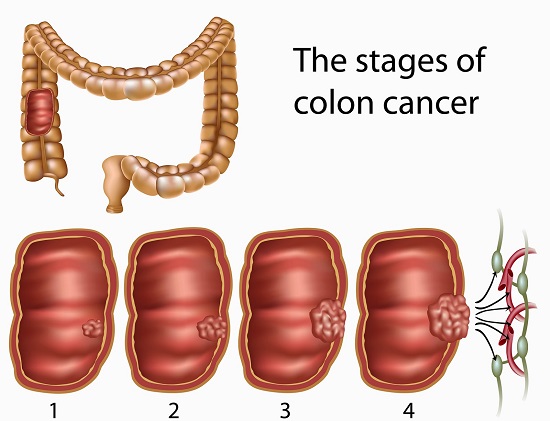 etapas del cncer del colon