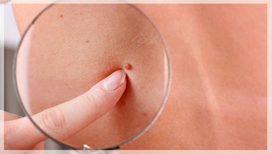 cáncer de célula escamosa cáncer de célula escamosa