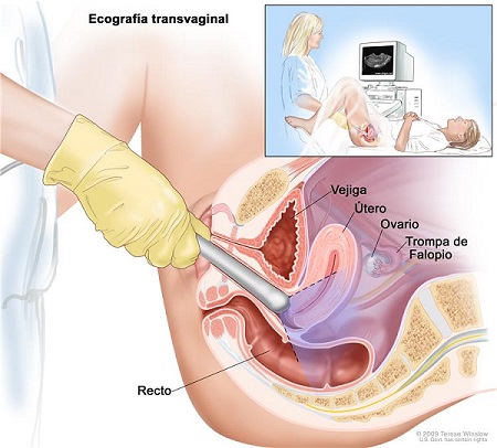 ecografa transvaginal