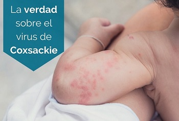 la verdad sobre el virus coxsackie