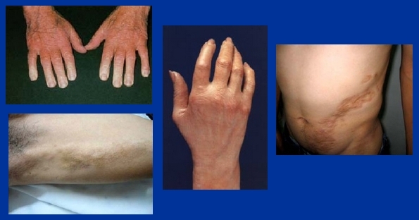 Causas Y S ntomas De La Esclerodermia