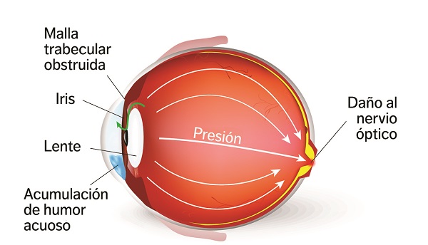 causas del glaucoma