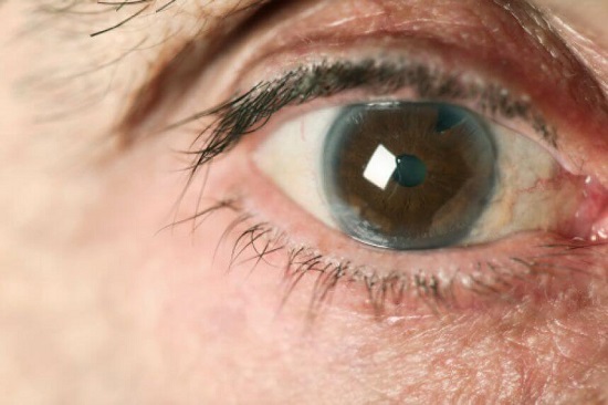 síntomas del glaucoma síntomas del glaucoma