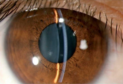 glaucoma secundario glaucoma secundario