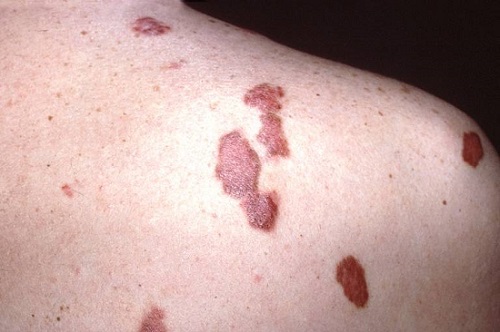 sarcoma de kaposi sarcoma de kaposi