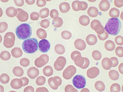 leucemia linfoctica