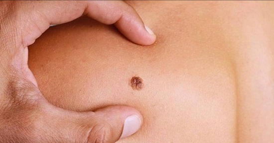 melanoma melanoma