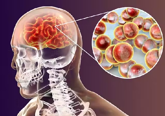 la meningitis y sus causas la meningitis y sus causas