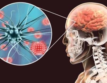 todo sobre la meningitis