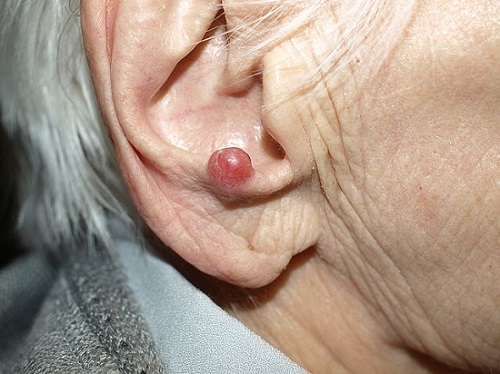 carcinoma de células de merkel carcinoma de células de merkel
