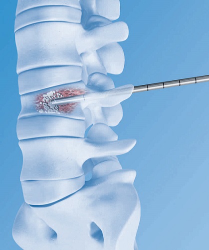 ciruga vertebroplastia para tratar fracturas provocadas por la osteoporosis