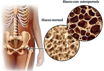 qu es la osteoporosis
