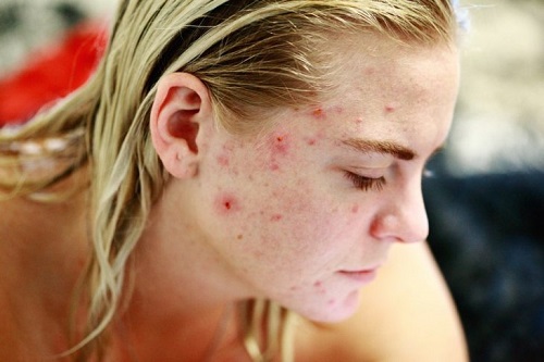 dermatitis atpica