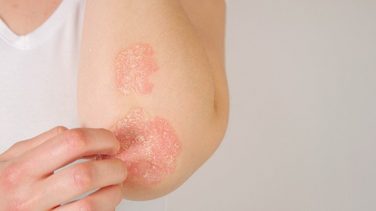 qu es la psoriasis?