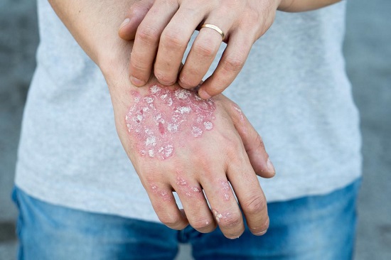 caractersticas de la psoriasis