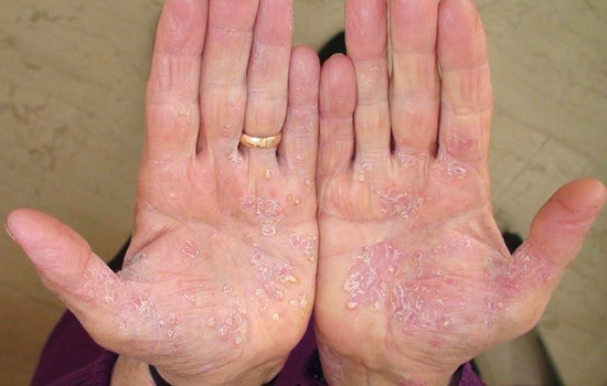 psoriasis en las palmas de la mano