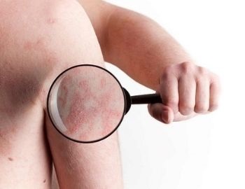 causas de la psoriasis