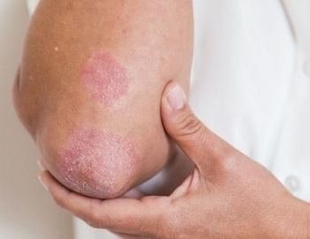 tipos de psoriasis