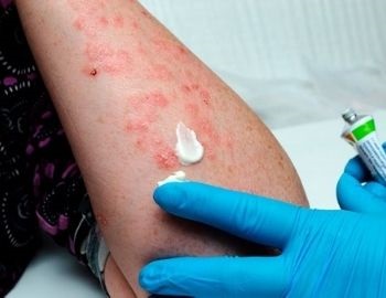 tratamiento contra la psoriasis