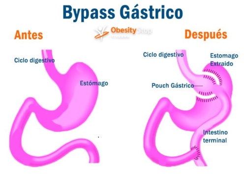 bypass gstrico