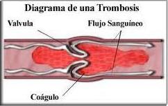 trombosis