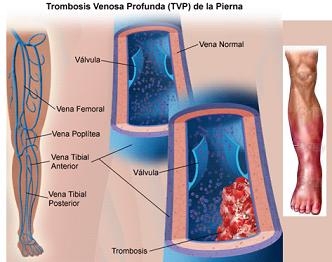 síntomas de la trombosis síntomas de la trombosis