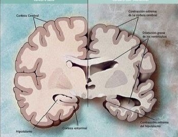 el alzheimer y sus fases