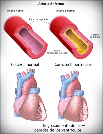 cardiopatas ms comunes en la hipertensin