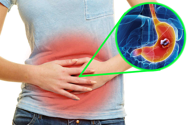 sntomas del cncer de estmago