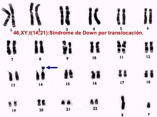 sndrome de down por translocacin