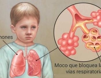 pulmones con fibrosis qustica