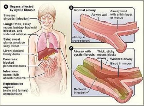 caractersticas de la fibrosis qustica