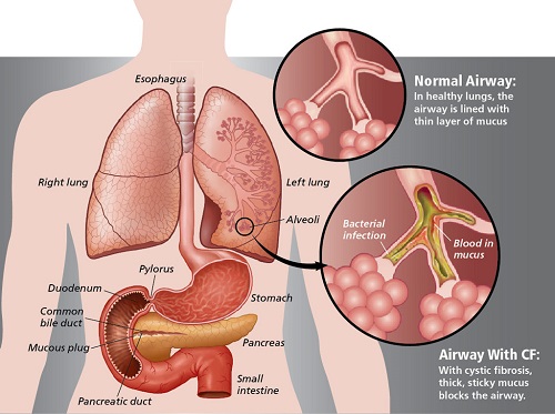 formacin de moco en los pulmones