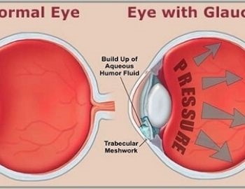 causas del glaucoma