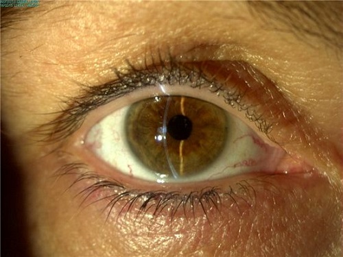 sntomas del glaucoma de ngulo cerrado