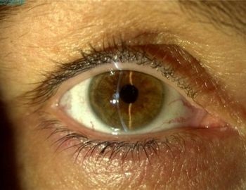 sntomas de los diferentes tipos de glaucoma