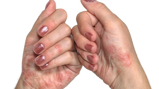 psoriasis en las manos y uas