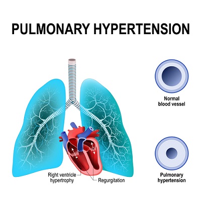 qu es la hipertensin pulmonar?