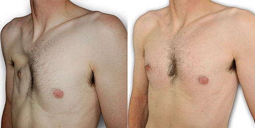 s�ntomas del s�ndrome de poland