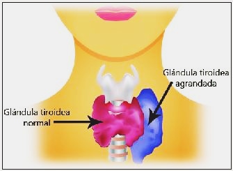 qu es el hipertiroidismo?<p height=245 width=335>Hipertiroidismo es una afeccin en la cual la glndula tiroides produce demasiada hormona tiroidea en sangre, lo que produce una aceleracin generalizada de las 
 funciones del organismo. La afeccin a menudo se denomina 