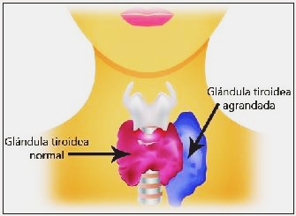 qu es el hipertiroidismo
