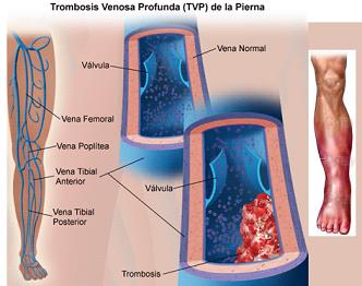 sntomas de la trombosis
