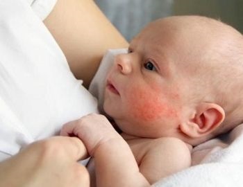 conoce el herpes neonatal simple tipo 1